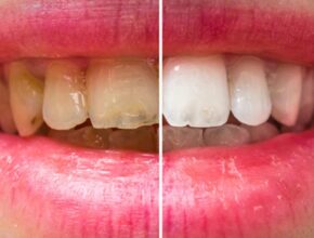 teeth