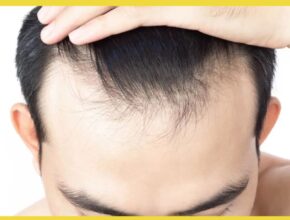 Thinning hair