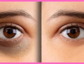 home remedy for dark circles