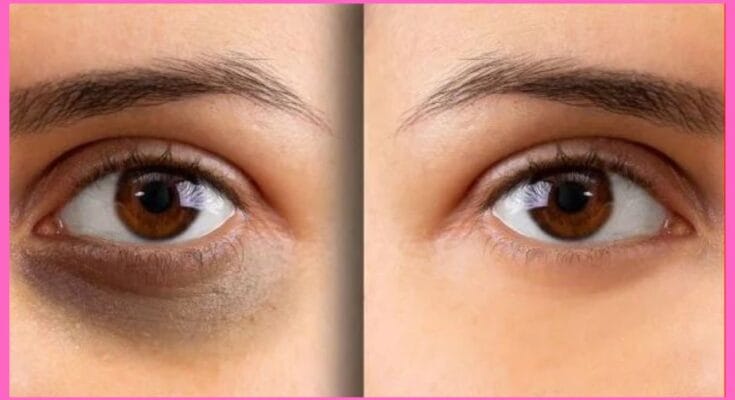 home remedy for dark circles