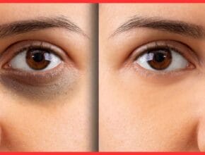 Homemade Eye Cream For Dark Circle