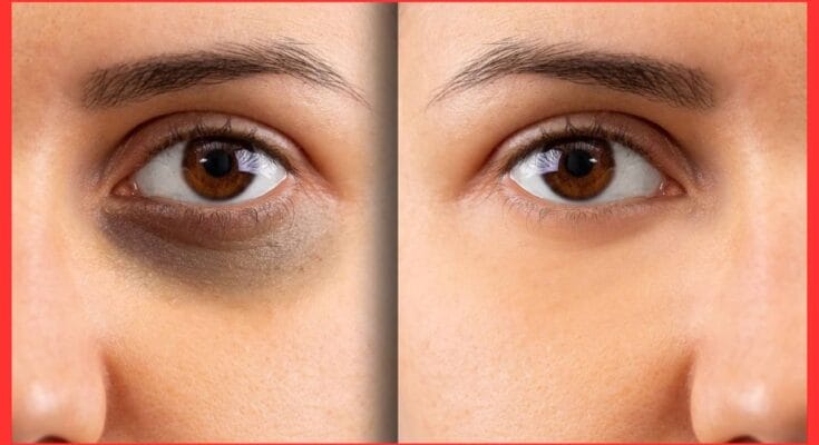 Homemade Eye Cream For Dark Circle