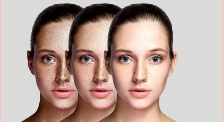 cream for pigmentation